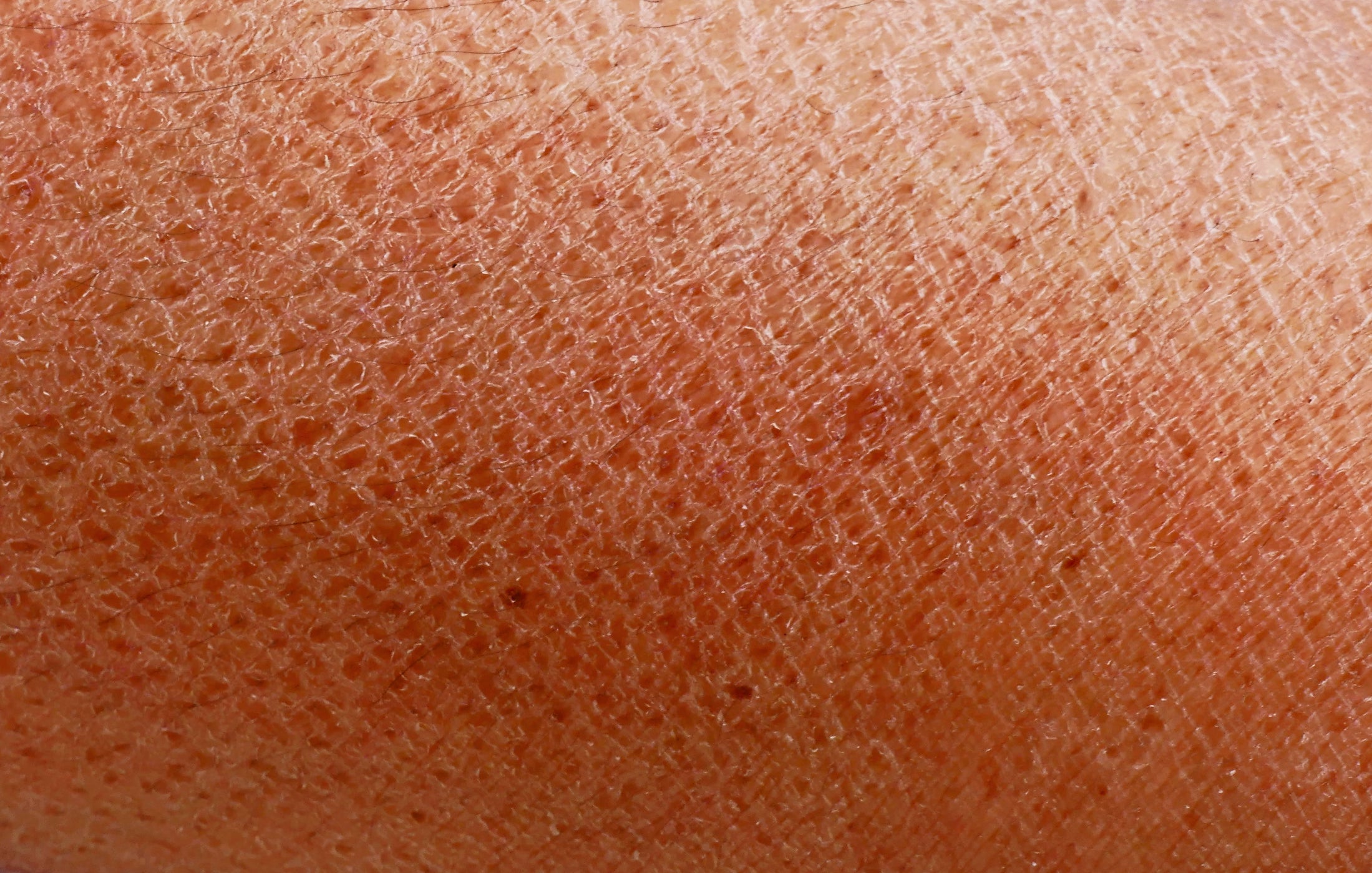 Detailaufnahme rissiger Haut